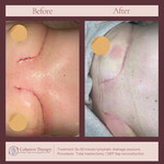 Mastectomy Scar Healing 