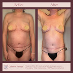 Mastectomy Recovery 